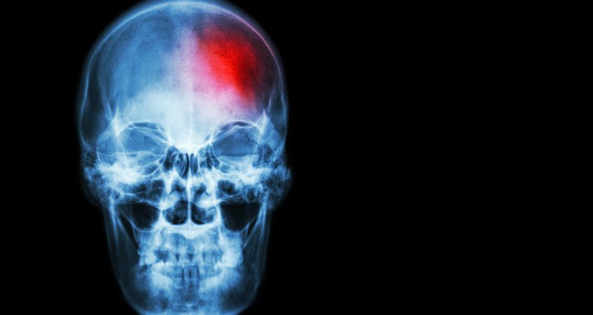 stroke symptoms
